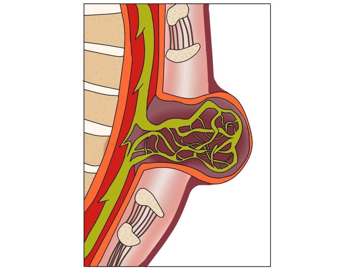 Miyelomeningosel, omurilik ve omurilik sinirlerinin yer değiştirdiği açık bir spina bifida.